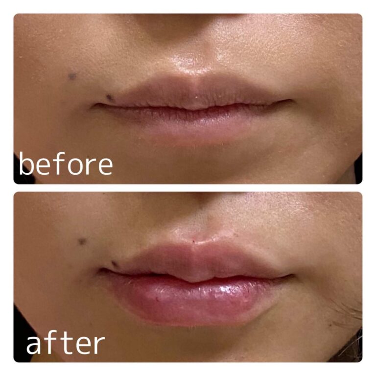 ヒアルロン酸注入について