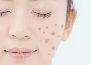 色素沈着について