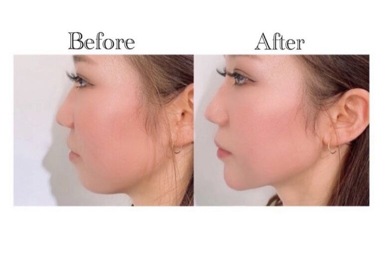 『Eラインで横顔美人に♡』