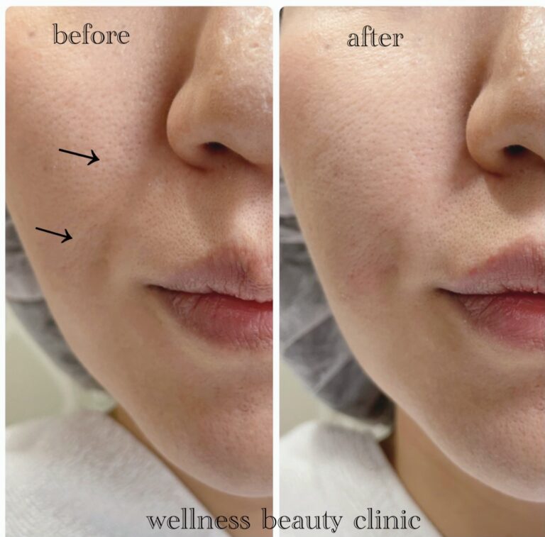 ほうれい線のお悩みに