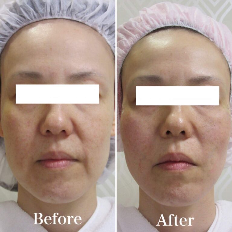 たるみケアに『TESSLIFT』（テスリフト）