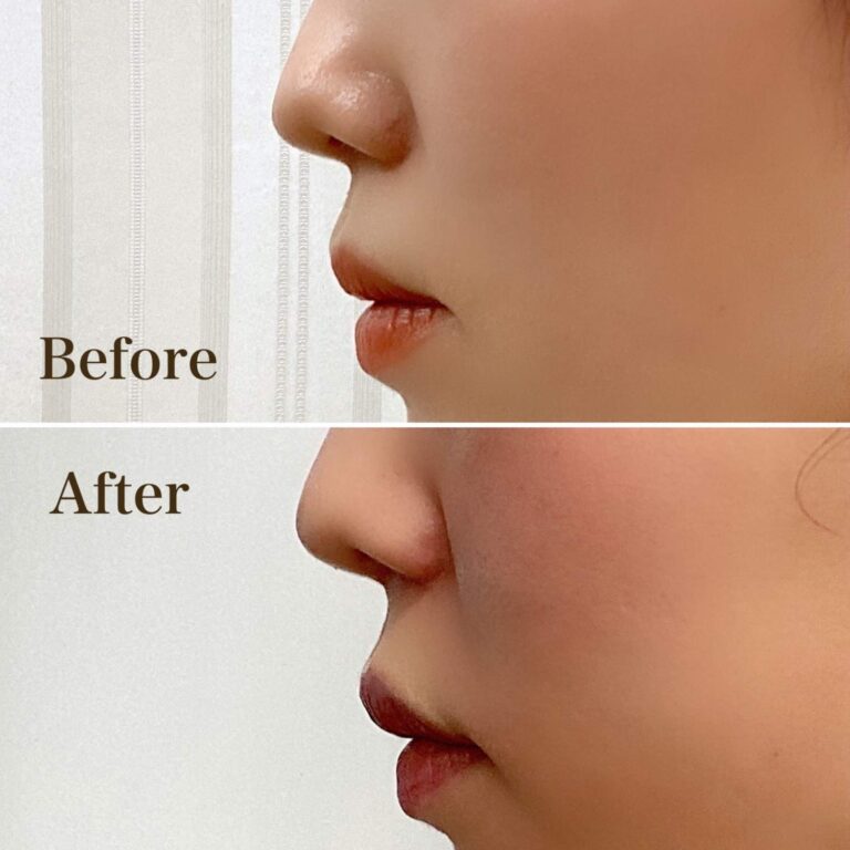 切らない人中短縮～ボトックス注射～