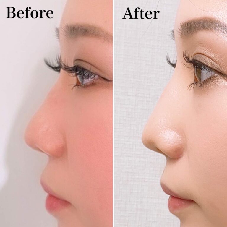 ★新メニュー～テスリフトノーズ～★