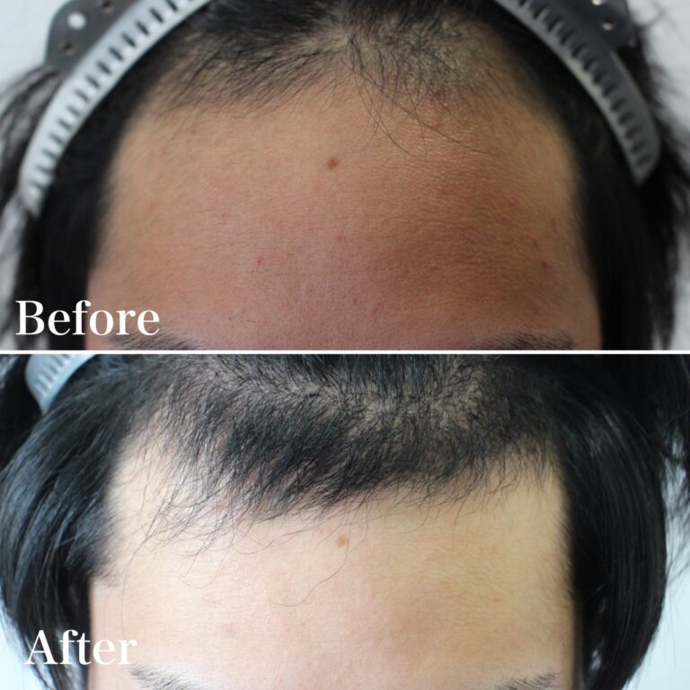 植毛の症例写真