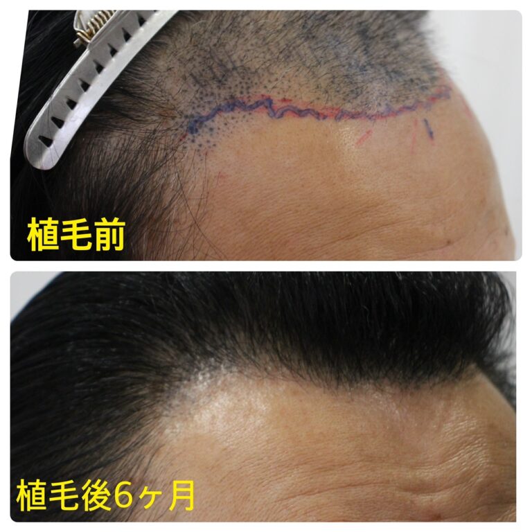 自毛植毛FUTについて