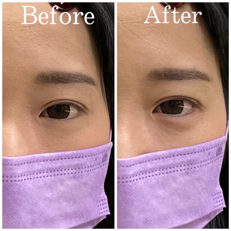 涙袋ヒアルロン酸