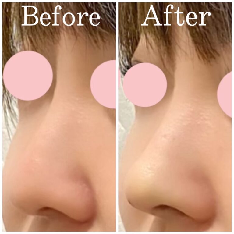 第三世代のスレッド～テスリフトノーズ～