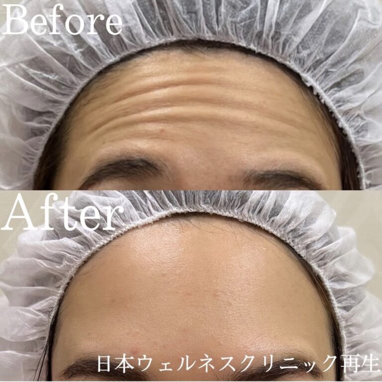 シワでお悩みの方に