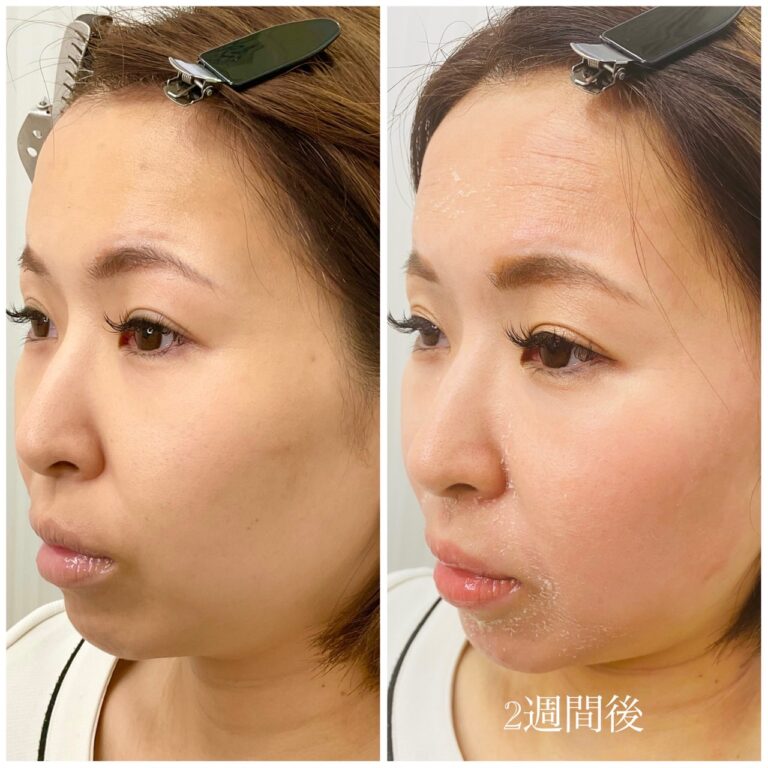 ゼオスキン「セラピューティック」について