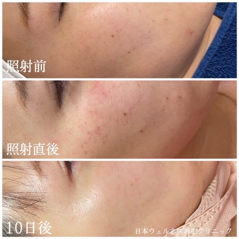 フォトRF導入★★