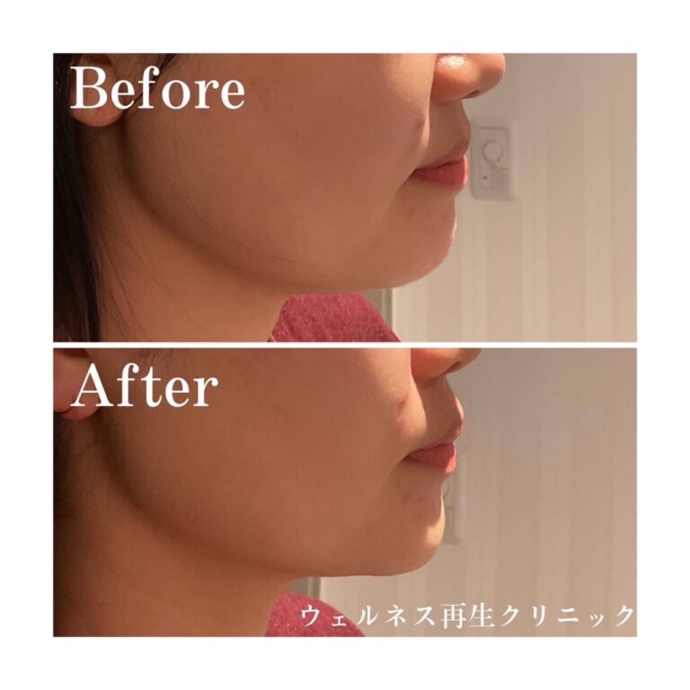 切らないたるみ治療・医療HIFU