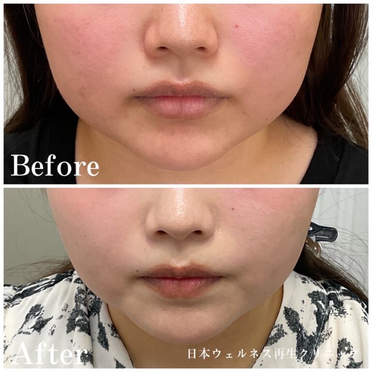 エラボトックス　症例写真