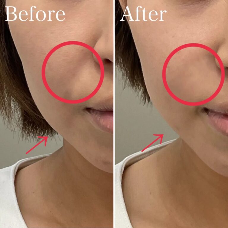 ウルトラマイクロボトックス(+羊膜由来幹細胞培養上清液)