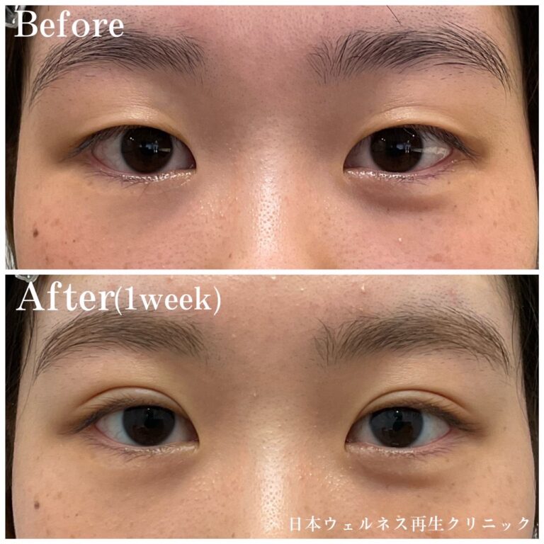 手軽にできる二重埋没法👀