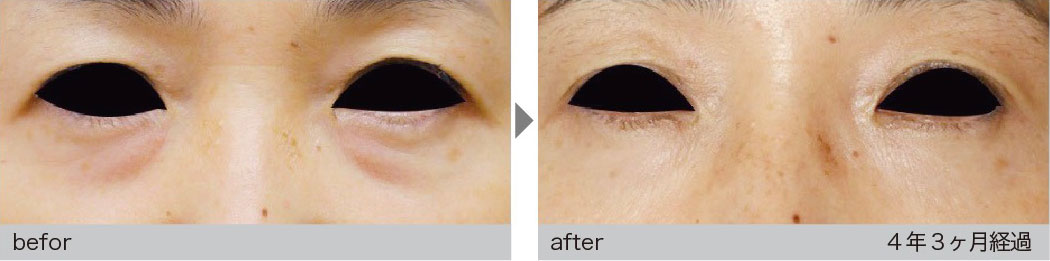 肌細胞治療による症例