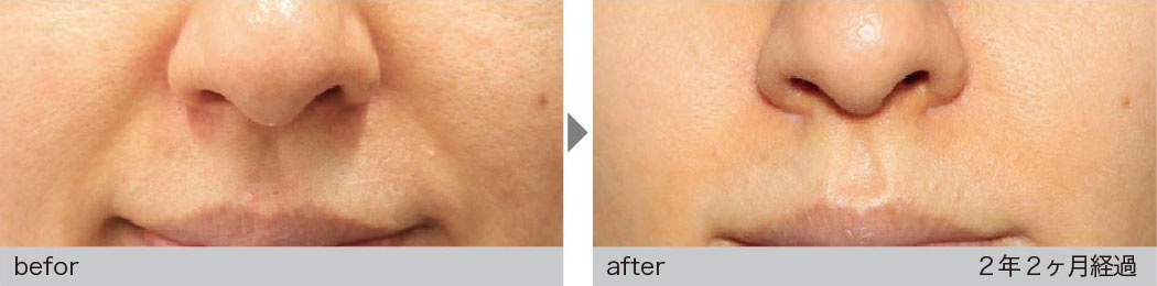 肌細胞治療による症例