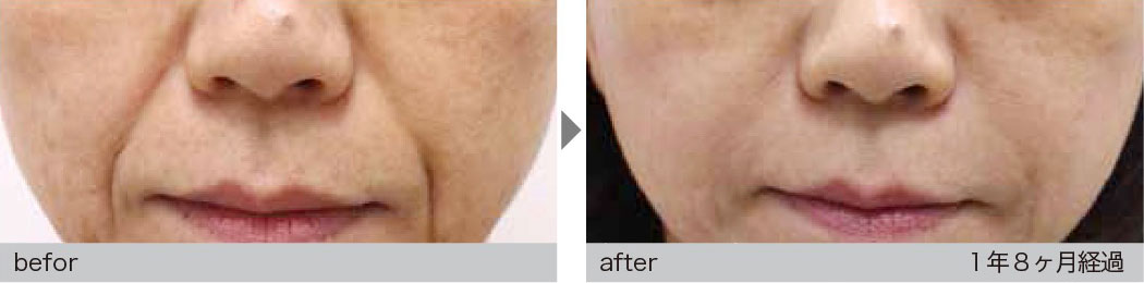 肌細胞治療による症例