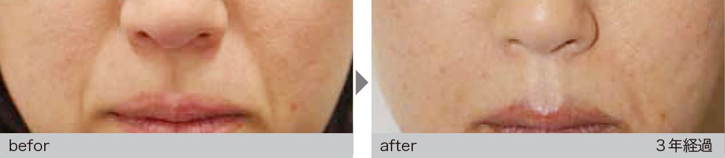 肌細胞治療による症例