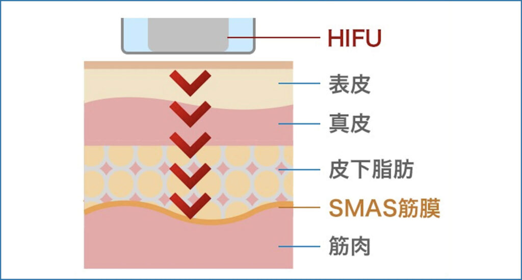 小顔ソニックリフトとは