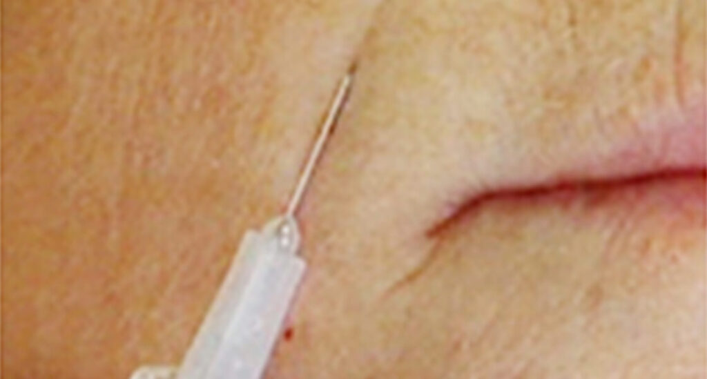 ヒアルロン酸によるシワ除去、若返り