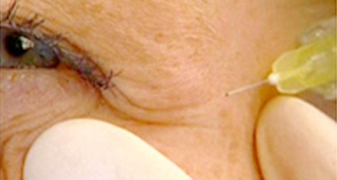 ヒアルロン酸によるシワ除去、若返り