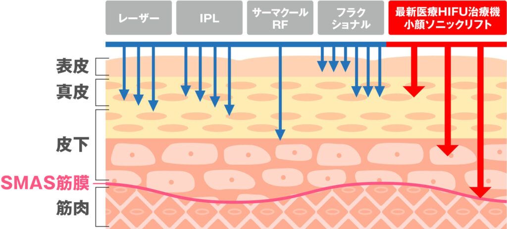 小顔ソニックリフト（HIFU）