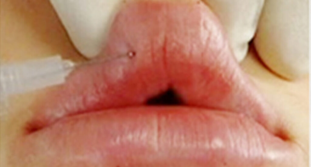 ヒアルロン酸によるプチ整形