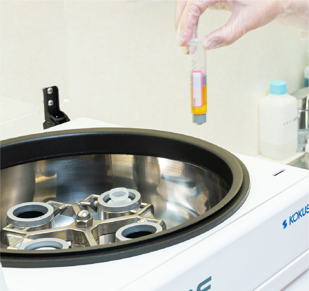 自分の血液で毛髪再生